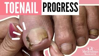 Toenail Reattachment Pedicure for Men | Follow-Up Pedicure With Powerful Life Lessons