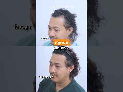 คุณหลุยส์ จากผมบาง สู่ผมจริง #hair #hairtransformation #ปลูกผม #beforeandafter #รีวิวปลูกผม #shorts