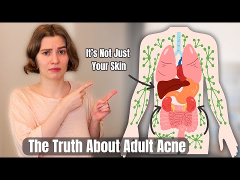 Adult Acne Why It Happens and How to Get Rid of It for Good