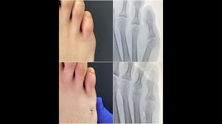 CIRUGIA MINIMAMENTE INVASIVA DE JUANETILLO (JUANETE DE SASTRE)