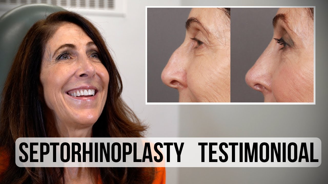 Septorhinoplasty testimonial with before-and-after images.