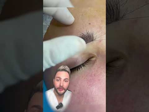 Evolución de la eliminación de piel en los párpados (blefaroplastia)