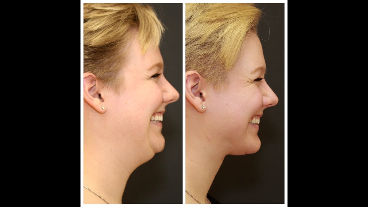 Before and after facial transformation side profile.