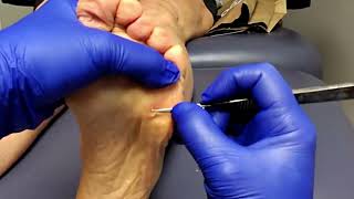 Massive Callus Cleanup by Dr. Nail Nipper | Real Patient Foot Health - Patient 1