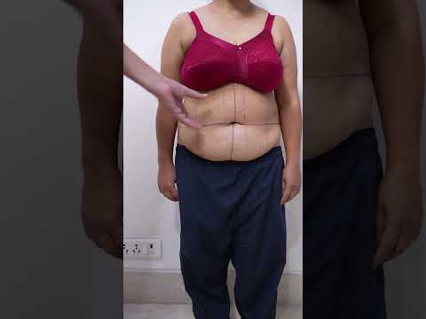 Tummy Tuck Surgery marking & planning #shorts #ytshort