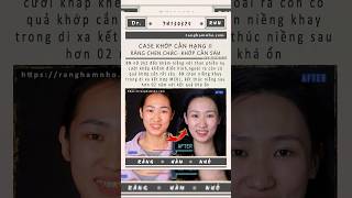 CASE CLASS II - RĂNG CHEN CHÚC