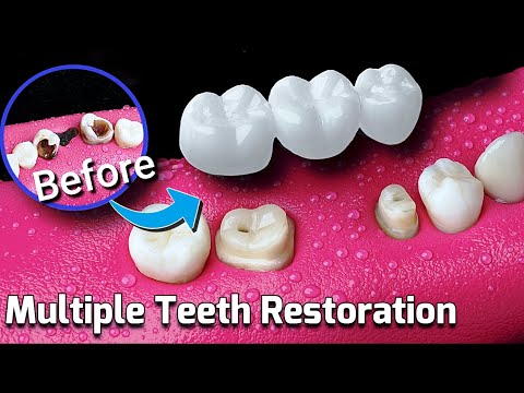 EXTREMELY SATISFYING Restoration of Lost Teeth | Dental Bridge Procedure