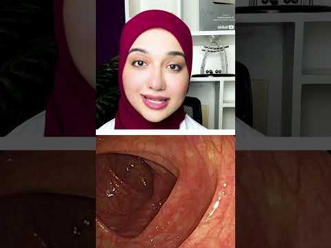 مش هتصدق شكل القولون الغير صحى تحت المنظار بسبب الامساك المزمن و تحجر الفضلات والملينات