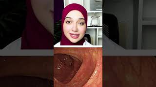 مش هتصدق شكل القولون الغير صحى تحت المنظار بسبب الامساك المزمن و تحجر الفضلات والملينات
