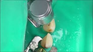 Restoring broken front tooth #teethdecay #dentist
