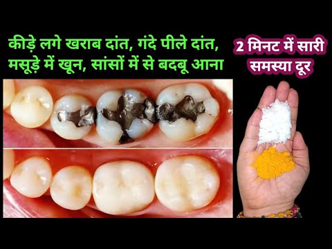 सिर्फ 2 मिनट में गंदे दांतों को मोती की तरह चमका देगा यह घरेलू नुस्खा Teeth whitening Remedy