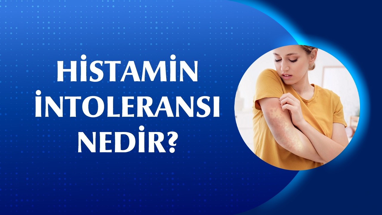 Histamin İntoleransı Nedir? Belirtileri Nelerdir?