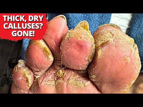 Satisfying Callus Removal! Watch Thick, Dry Skin Get Trimmed Down