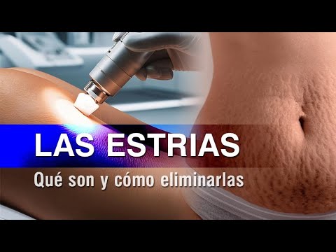 Qué son las Estrías, cómo se forman y cómo eliminarlas