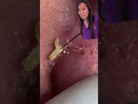 Pro tip: if you are going to extract your blackheads