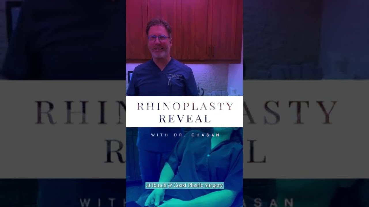 Rhinoplasty Reveal - #17