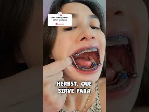 ¿Porque lleva esas extrañas barras o muelles en los brackets?