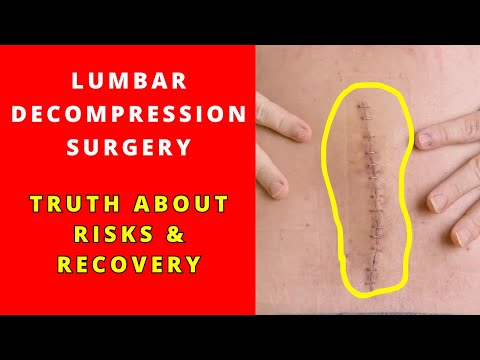 Complications of Lumbar Decompression Surgery: A Must-Watch Guide