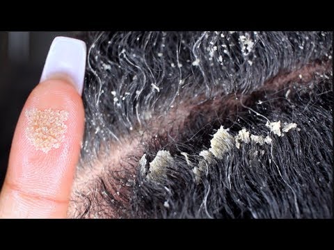 MY BIGGEST FLAKES EVER PART 2 | Scalp scratching and picking | Satisfying Dandruff Removal ASMR