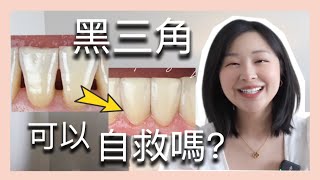 『黑三角必看』牙縫越來越大？預防黑三角 三個關鍵方法 | 不要亂刷牙！