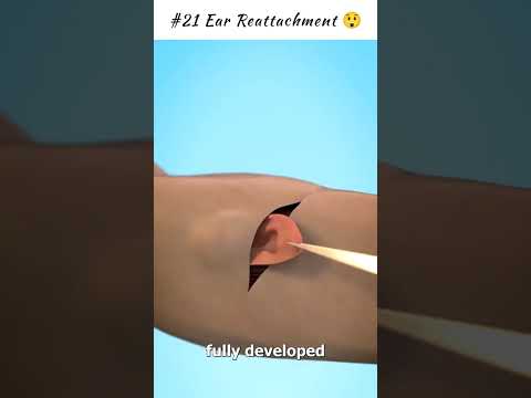 Ear Reattachment 😲