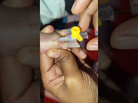 IV Cannulation technique part 86 #mbbs #shortvideo