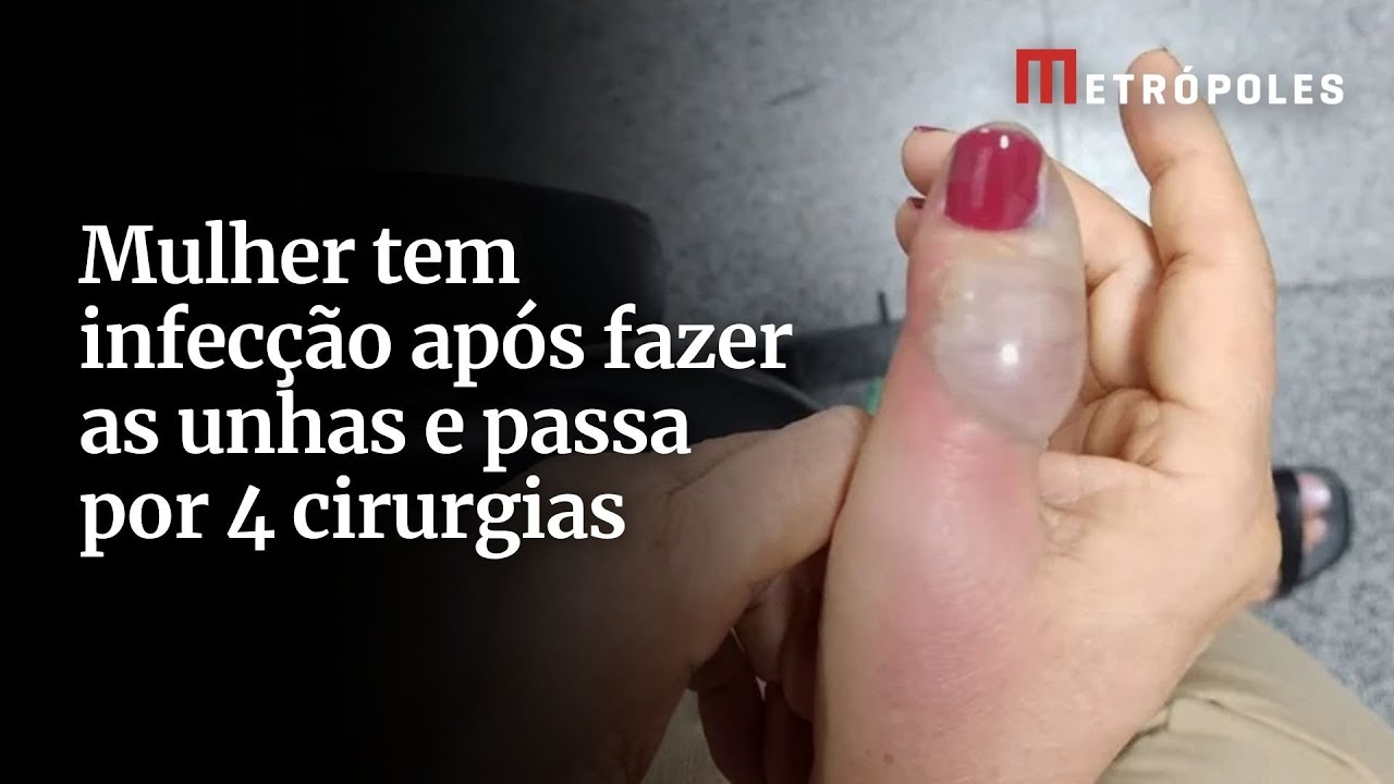 Mulher tem infecção após fazer as unhas e passa por 4 cirurgias