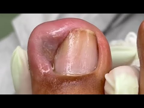 FOI MANDAR A MANICURE  DESENCRAVAR A UNHA E FICOU PIOR 😷 Podologia Podologa Kelly Freitas