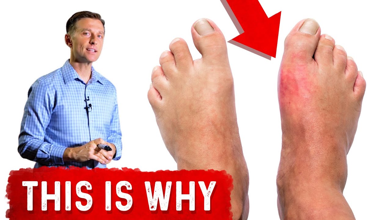 Why do you get gout in your Big Toe?