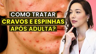 ACNE DA MULHER ADULTA: o que é, tratamentos e como controlar de vez I Dermato explica!