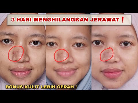 CUMA 3 HARI ❗️CARA MENGHILANGKAN JERAWAT & BEKAS JERAWAT