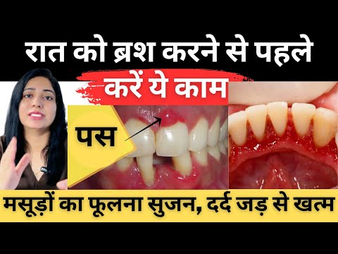 मसूड़े की सूजन, दर्द और पस् को जड़ से दूर करने का घरेलु तरीका | Masude Ki Sujan Ka Gharelu Ilaaj |