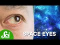 Understanding Spaceflight-Associated Neuro-Ocular Syndrome (SANS)