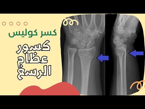 كسر عظم الكعبرة والرسغ