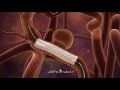 Understanding Cerebral Aneurysms and Endovascular Treatment