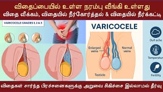 விதைப்பை நரம்பு வீங்கி உள்ளது (வெரிகோஸ் வெய்ன்) | விதை வீக்கம் & நீர்கோர்த்தல் #hydroceletreatment