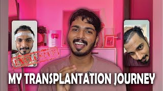 My Hair transplantation Journey💇 | Hair Transplantation | @itsallabout.SayedAnwar #hairtransplant