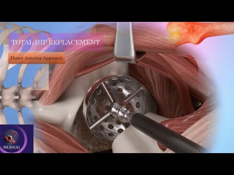 Total Hip Replacement (Direct Anterior Approach) | Minimally Invasive Surgery