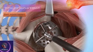 Total Hip Replacement (Direct Anterior Approach) | Minimally Invasive Surgery