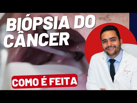 Biópsia do Câncer de Garganta: Veja como é feita