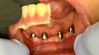 Why We Tried Two-Pieces Instead of One for This Restoration