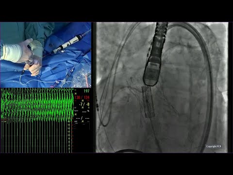 Leading innovation for patients with valvular heart disease - PCR London Valves 2024