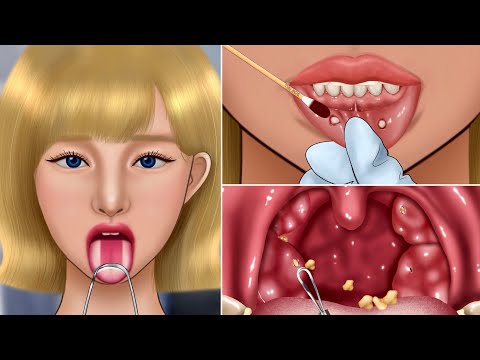 ASMR Satisfying Tonsil Stone Removal Animation‼️ The cause of Bad Breath