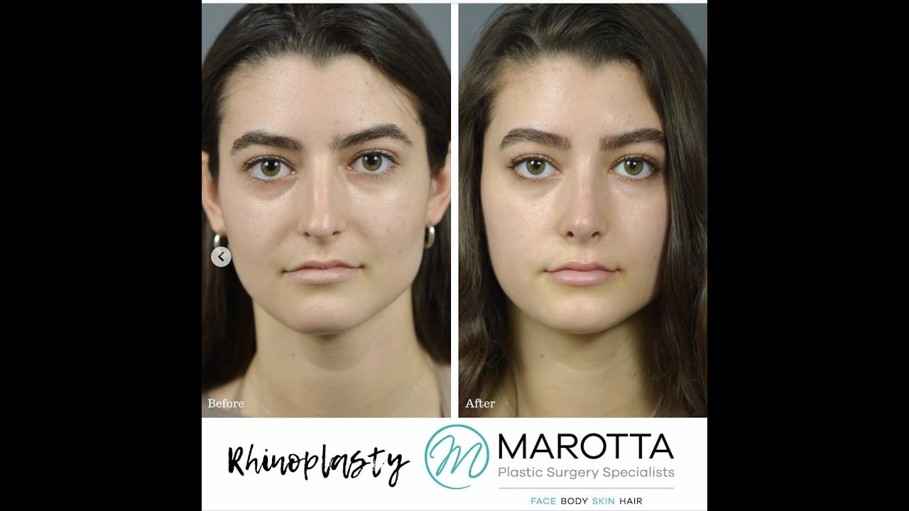Before and after rhinoplasty results comparison.