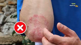 দাদ চুলকানি দূর করার উপাই । chulkani treatment bangla