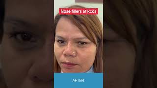 Nose fillers: non surgical nose lift