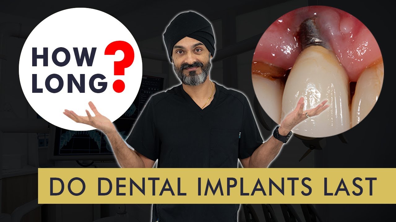 How Long Does A Tooth Implant Last