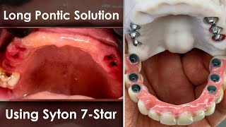 Well-Managed Huge Pontics from 7-Star Ceramics