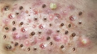 Loan Nguyen Acne Treatment 120c