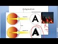 Refractive Errors and Visual Symptoms
